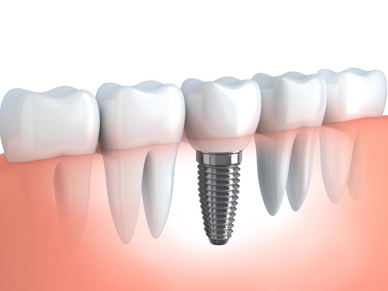 Dental Implants Butler, IN