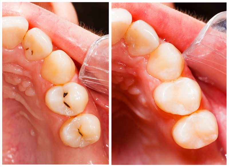 Fillings  Butler, IN 