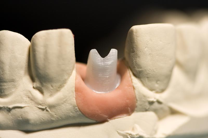 Implant Restoration Butler, IN