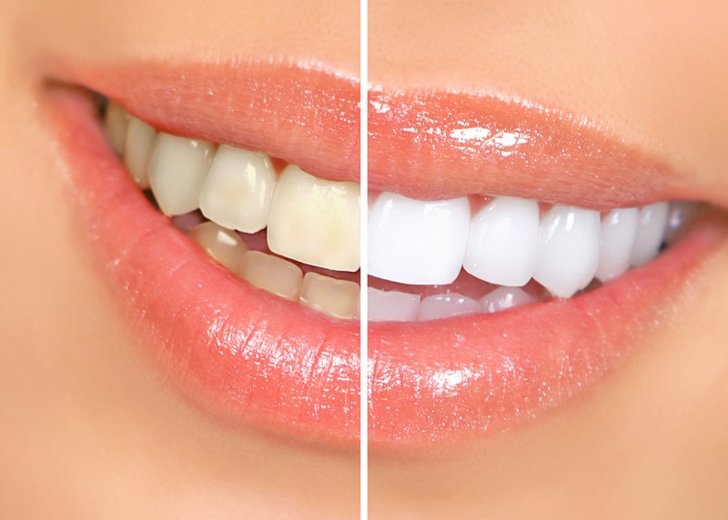 Teeth Whitening  Butler, IN 