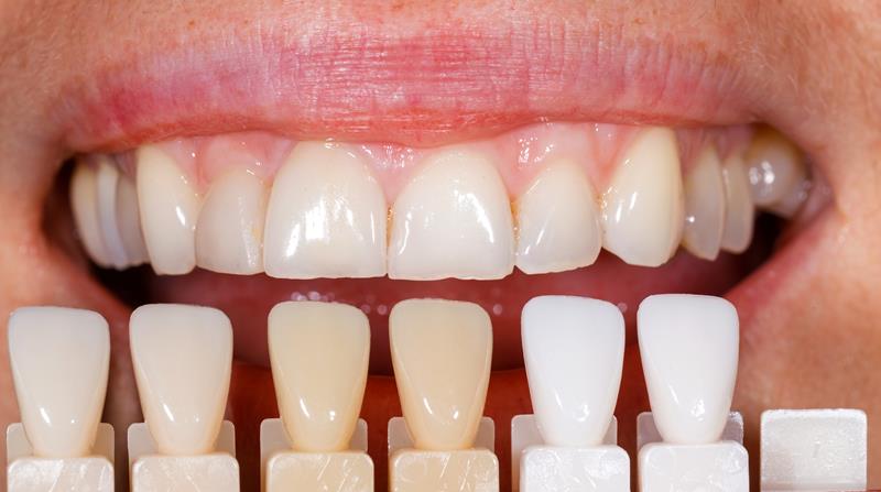 Veneers  Butler, IN 
